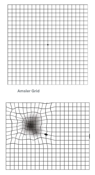 What causes macular degeneration?