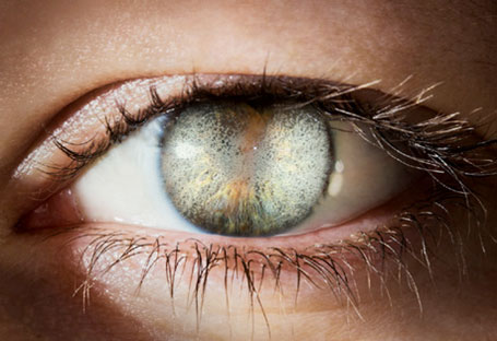What are corneal dystrophies