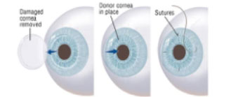 How is a corneal transplant determined