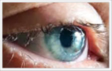 What is a corneal transplant?