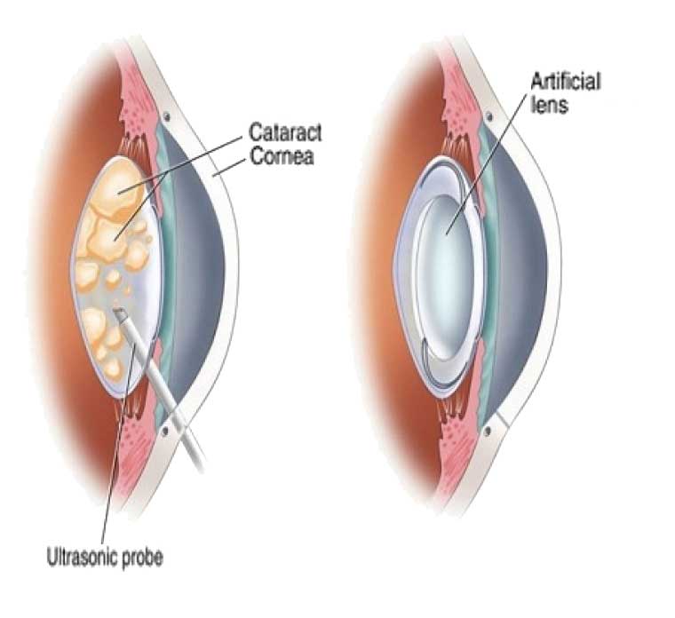 Posterior Capsulotomy