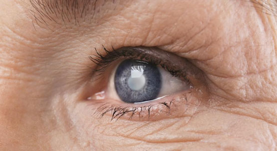 What is  glaucoma?