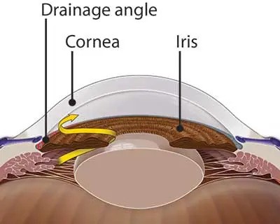 What causes  glaucoma