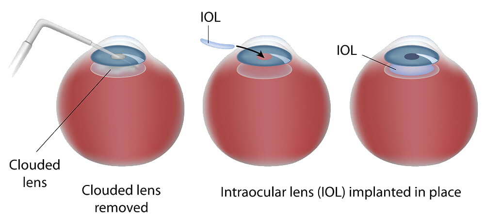 Intraocular Lens